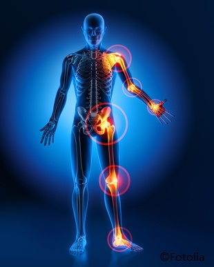Chronische Gicht durch konsequente Therapie behandeln