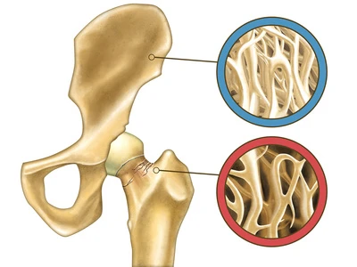 Oberschenkelhals poroes c Fotolia 52662138 Andrea Danti Gesundheitscheck Vorsorgeuntersuchung Diagnoseklinik