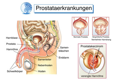 Prostataerkrankungen vergroessert Prostatakarzinom c henrie fotolia Gesundheitscheck Vorsorgeuntersuchung Diagnoseklinik