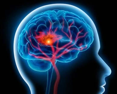 Schlaganfall Gehirninfarkt Gesundheitscheck Vorsorgeuntersuchung Diagnoseklinik