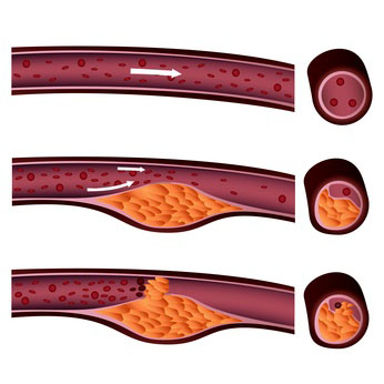 arteriosklerose plaque c fotolia bilderzwerg Gesundheitscheck Vorsorgeuntersuchung Diagnoseklinik