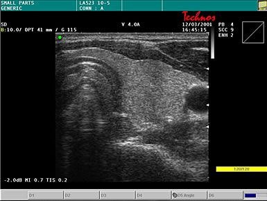 Sonographie einer gesunden Schilddrüse.