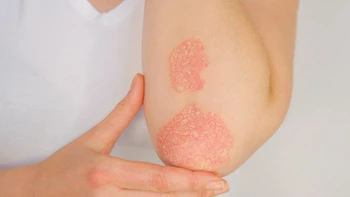 Schuppenflechte (Psoriasis) 