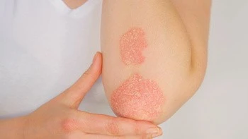 Schuppenflechte (Psoriasis) 