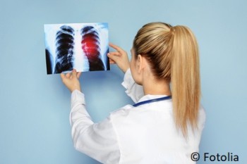 Lungenkrebs – Hohes Risiko auch nach Rauchstopp