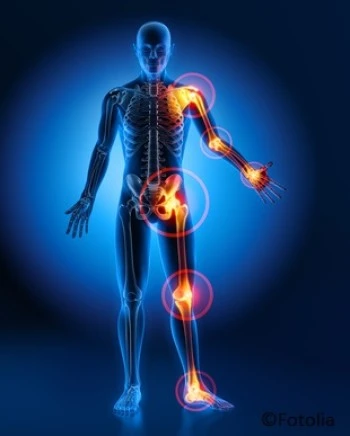 Chronische Gicht durch konsequente Therapie behandeln