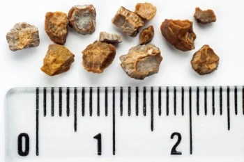 Gicht begünstigt ernsthafte Erkrankungen