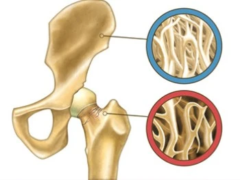 Mit Vitamin D, Kalzium und Bewegung Osteoporose vermeiden