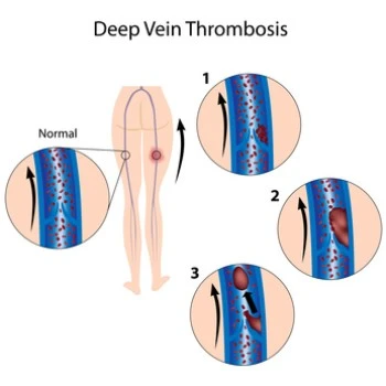 Jede Thrombose ist ein Notfall